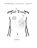 DETECTION AND MONITORING USING HIGH FREQUENCY ELECTROGRAM ANALYSIS diagram and image