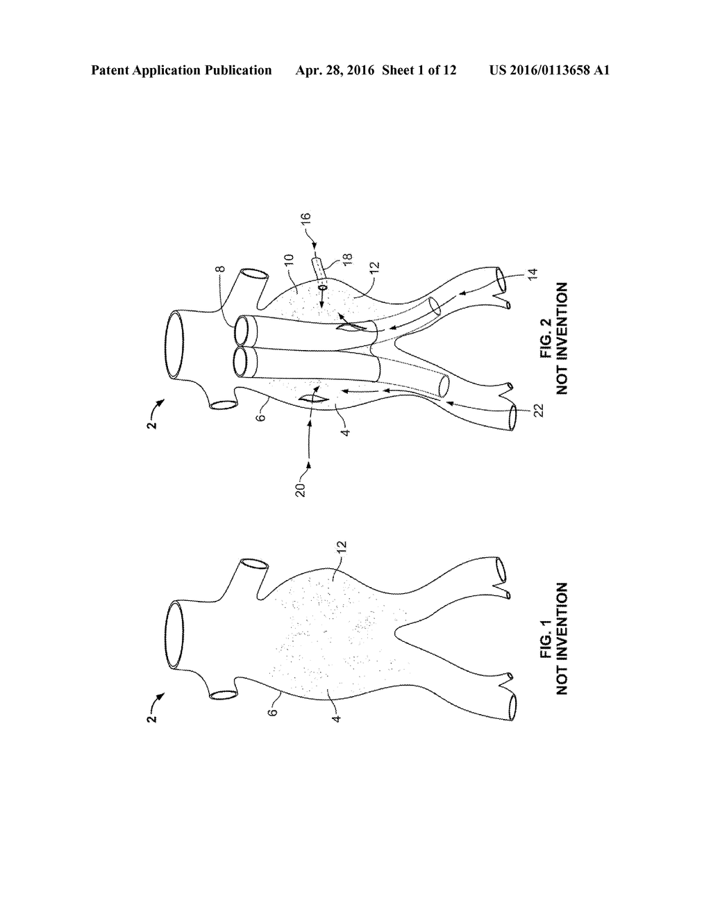 EMBOLIZATION DEVICE AND A METHOD OF USING THE SAME - diagram, schematic, and image 02