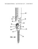 Bone fixation system diagram and image