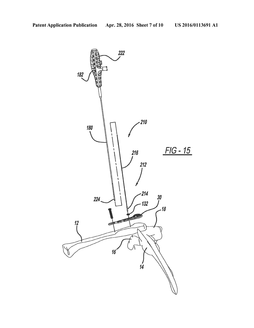 METHOD OF IMPLANTING A BONE FIXATION ASSEMBLY - diagram, schematic, and image 08