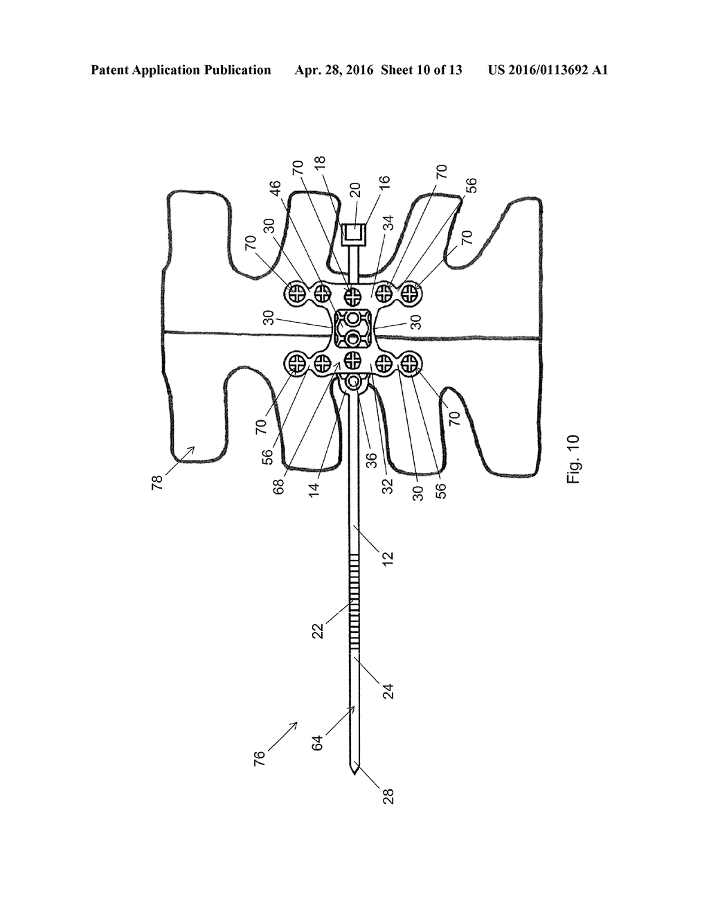 FIXATION ASSEMBLY WITH A FLEXIBLE ELONGATED MEMBER FOR SECURING PARTS OF A     STERNUM - diagram, schematic, and image 11