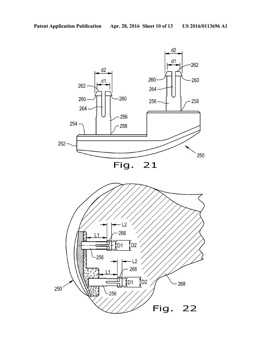 FIXATION OF BONE IMPLANTS - diagram, schematic, and image 11