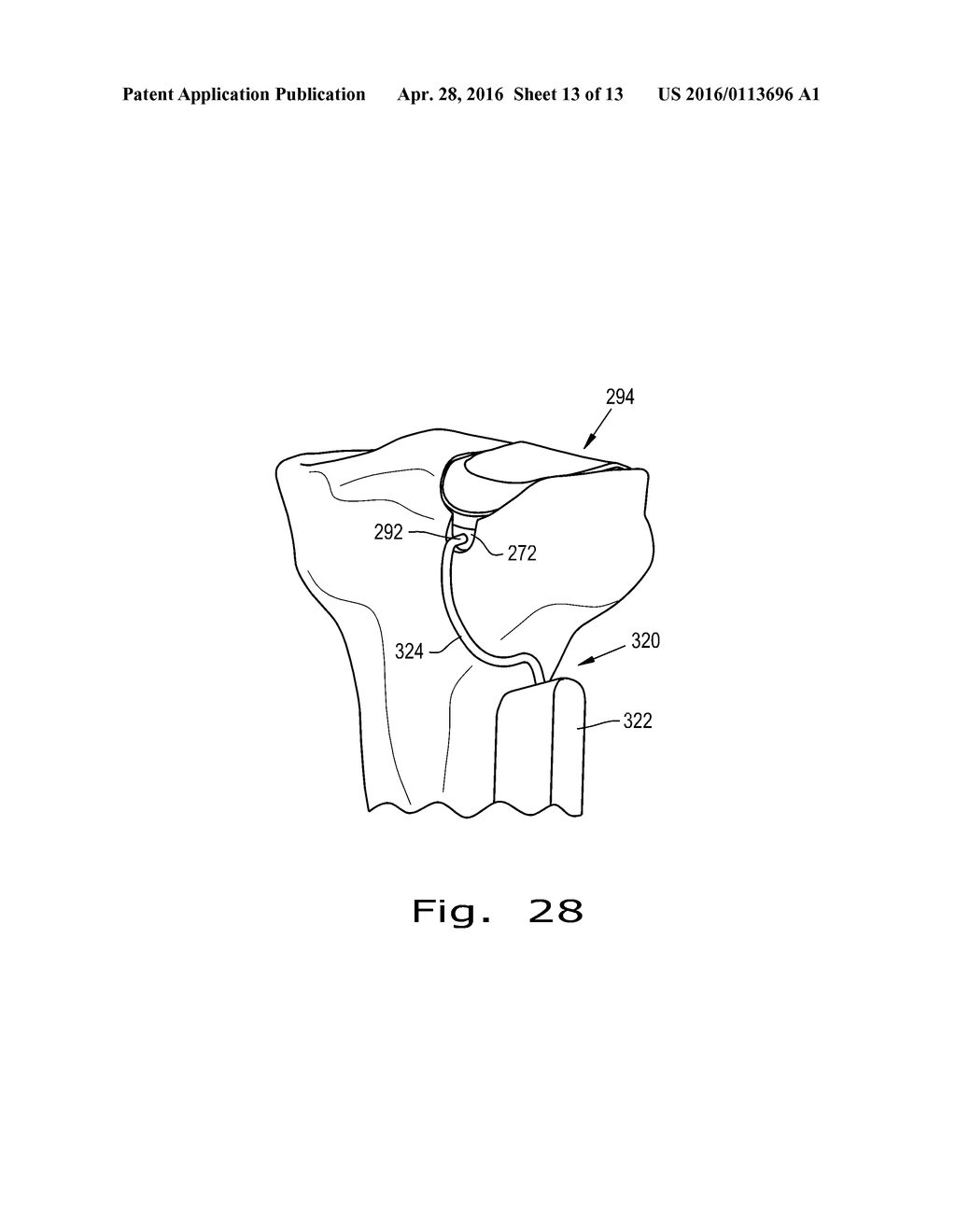 FIXATION OF BONE IMPLANTS - diagram, schematic, and image 14