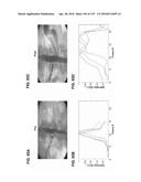 DEVICES AND METHODS FOR RENAL DENERVATION AND ASSESSMENT THEREOF diagram and image