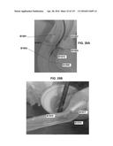 DEVICES AND METHODS FOR RENAL DENERVATION AND ASSESSMENT THEREOF diagram and image