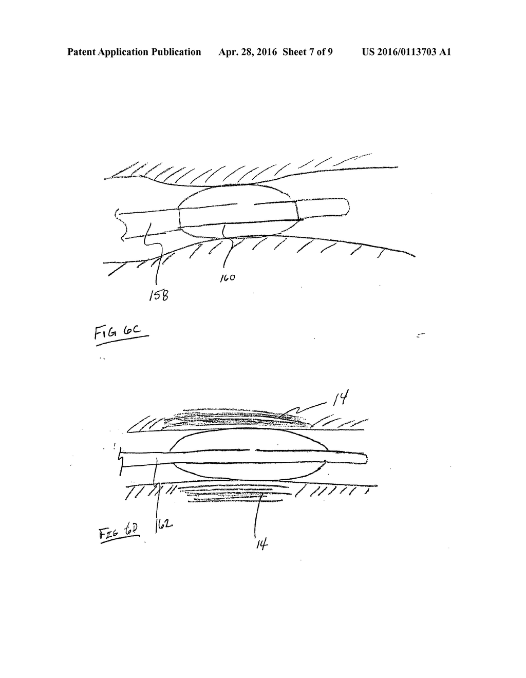 METHODS FOR TREATING AIRWAYS - diagram, schematic, and image 08