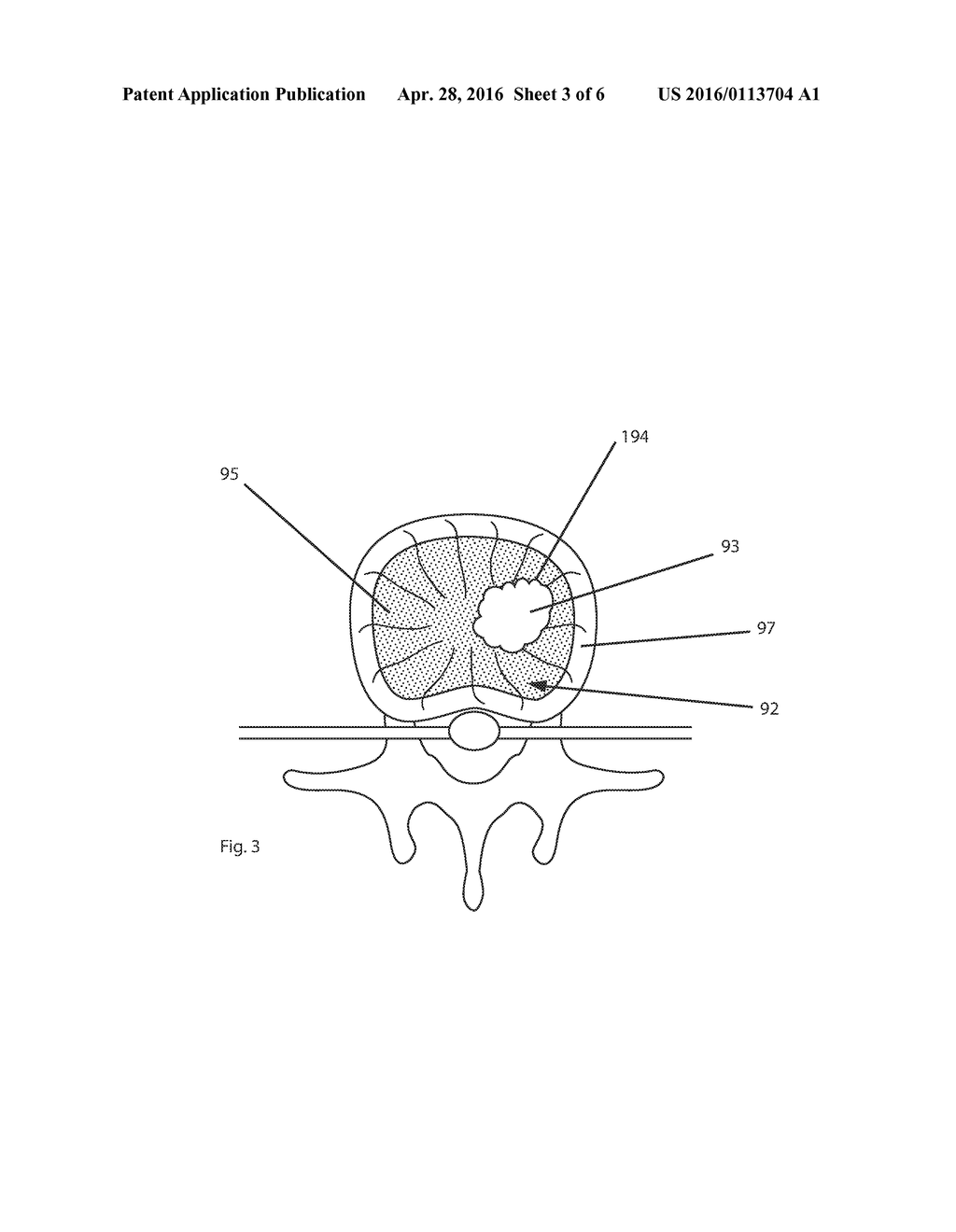 Electrosurgical Device & Methods - diagram, schematic, and image 04