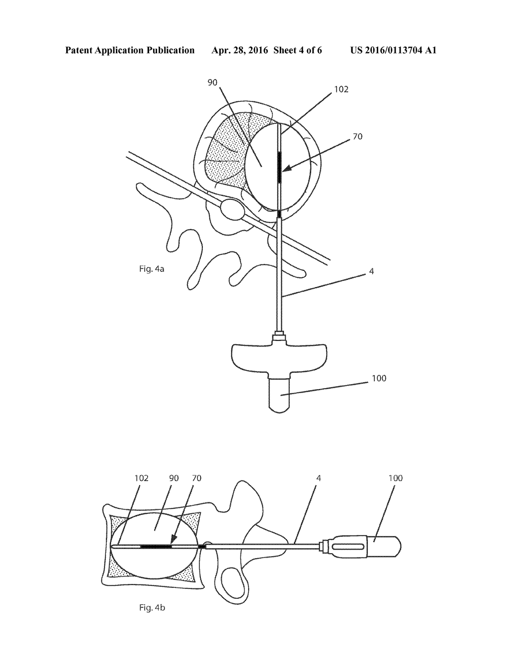 Electrosurgical Device & Methods - diagram, schematic, and image 05