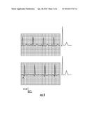 METHOD FOR COMPUTATIONALLY PREDICTING OPTIMAL PLACEMENT SITES FOR INTERNAL     DEFIBRILLATORS IN PEDIATRIC AND  CONGENITAL HEART DEFECT PATIENTS diagram and image