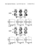 METHOD FOR COMPUTATIONALLY PREDICTING OPTIMAL PLACEMENT SITES FOR INTERNAL     DEFIBRILLATORS IN PEDIATRIC AND  CONGENITAL HEART DEFECT PATIENTS diagram and image