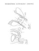 UROLOGICAL DEVICE diagram and image