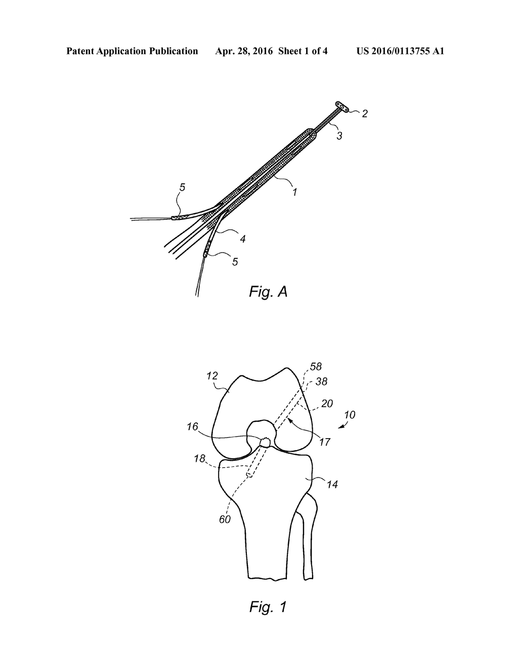 ELONGATE GUIDE ELEMENT FOR AN IMPLANT - diagram, schematic, and image 02