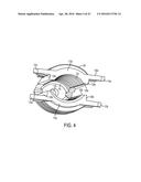 Biceps Tenodesis Implants and Delivery Tools diagram and image