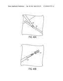 Biceps Tenodesis Implants and Delivery Tools diagram and image