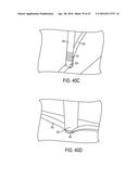 Biceps Tenodesis Implants and Delivery Tools diagram and image