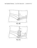 Biceps Tenodesis Implants and Delivery Tools diagram and image