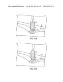 Biceps Tenodesis Implants and Delivery Tools diagram and image