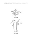 Biceps Tenodesis Implants and Delivery Tools diagram and image