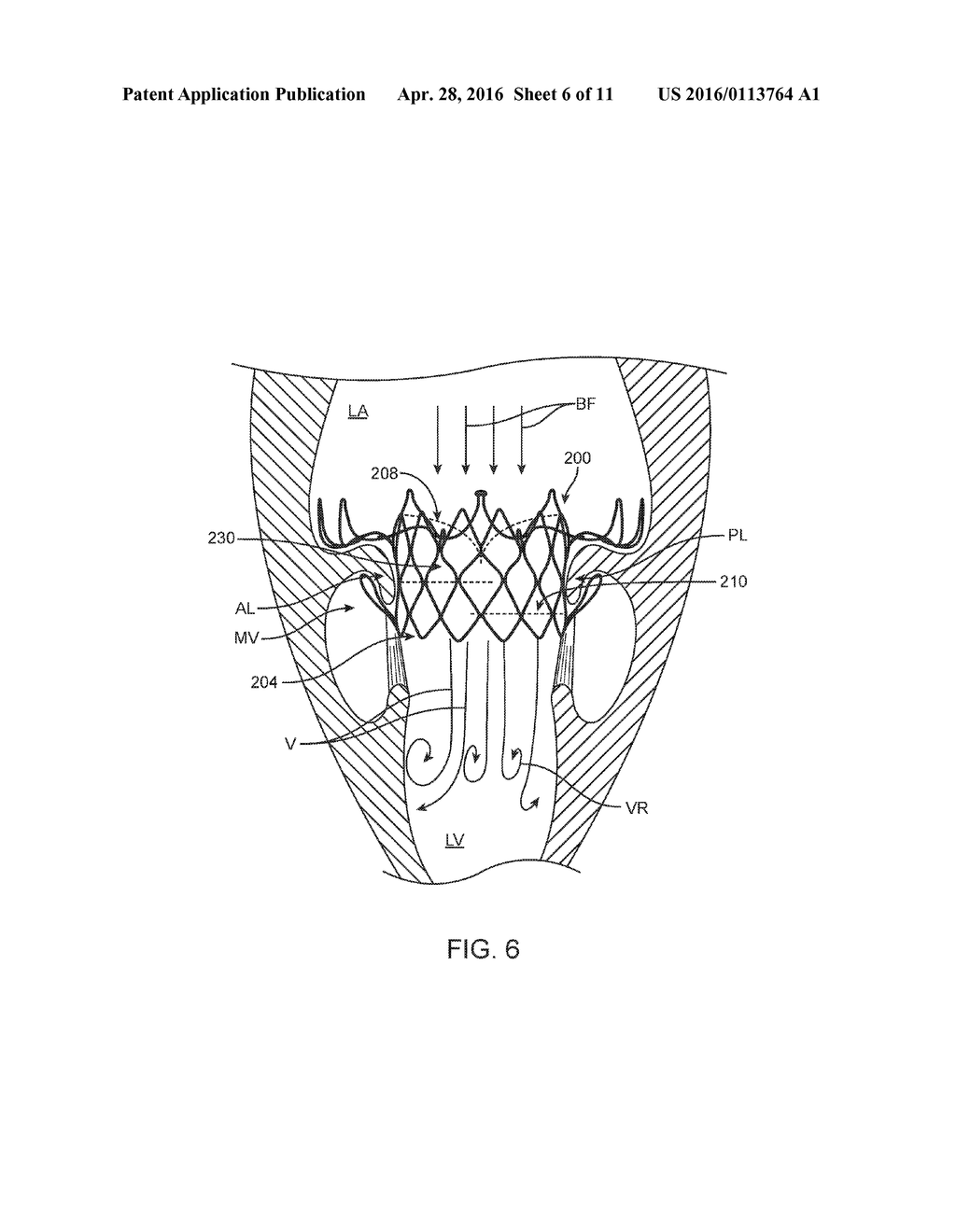 Prosthetic Valve With Flow Director - diagram, schematic, and image 07