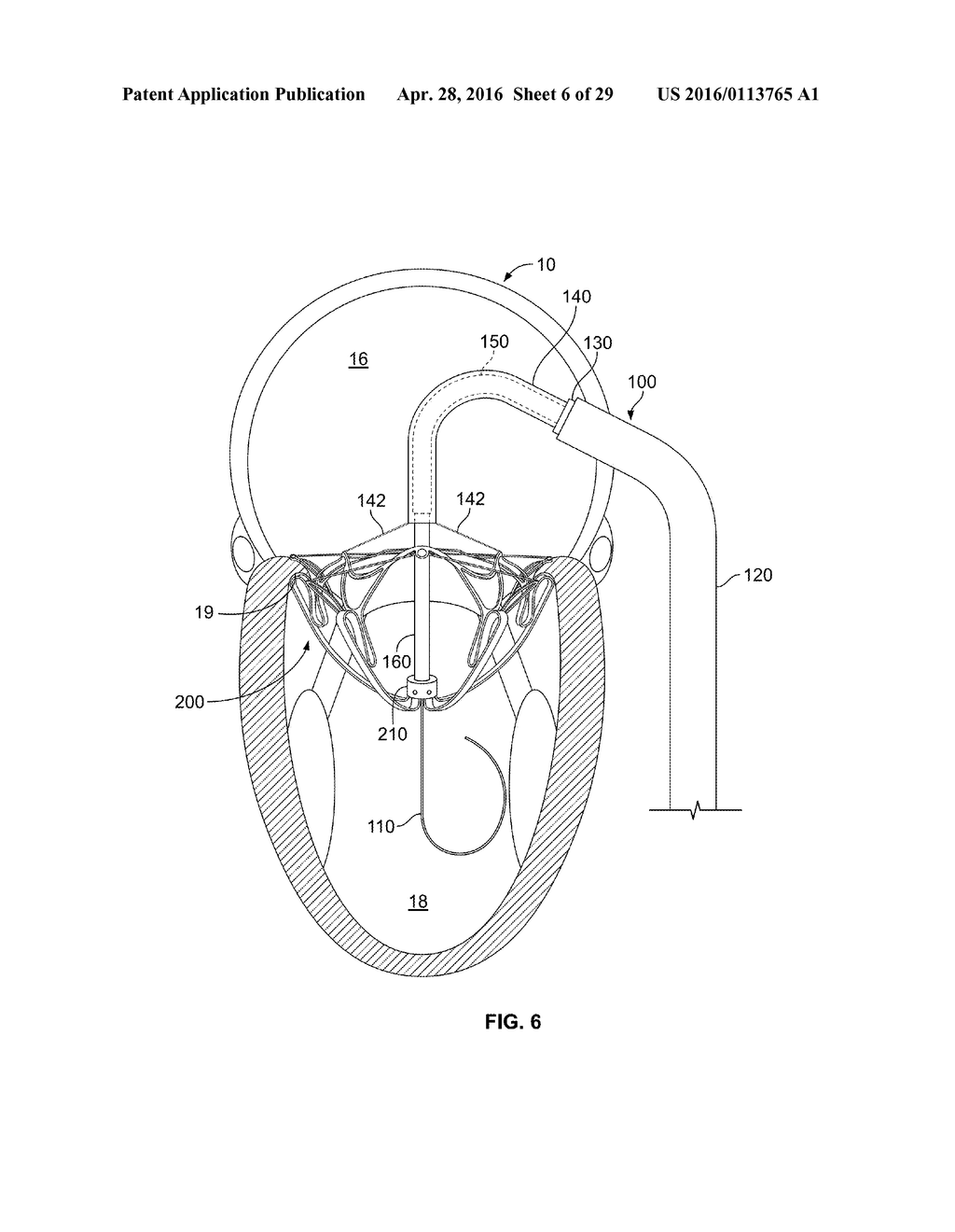 SYSTEMS AND METHODS FOR HEART VALVE THERAPY - diagram, schematic, and image 07