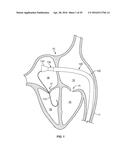 SYSTEMS AND METHODS FOR HEART VALVE THERAPY diagram and image