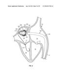 SYSTEMS AND METHODS FOR HEART VALVE THERAPY diagram and image