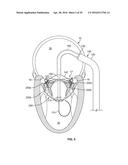 SYSTEMS AND METHODS FOR HEART VALVE THERAPY diagram and image