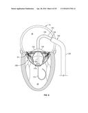 SYSTEMS AND METHODS FOR HEART VALVE THERAPY diagram and image