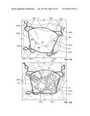 SYSTEMS AND METHODS FOR HEART VALVE THERAPY diagram and image