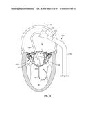 SYSTEMS AND METHODS FOR HEART VALVE THERAPY diagram and image