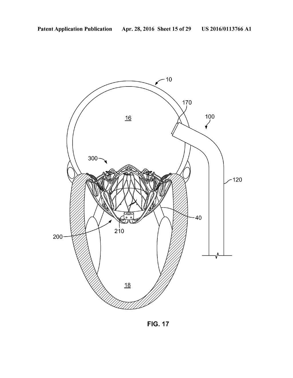 SYSTEMS AND METHODS FOR HEART VALVE THERAPY - diagram, schematic, and image 16