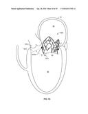 SYSTEMS AND METHODS FOR HEART VALVE THERAPY diagram and image