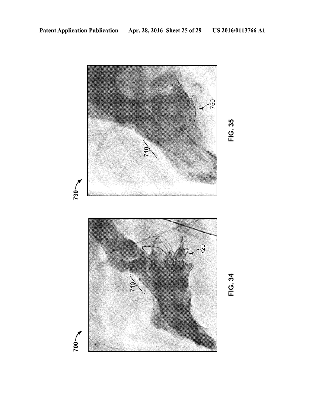 SYSTEMS AND METHODS FOR HEART VALVE THERAPY - diagram, schematic, and image 26