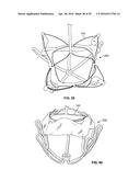 SYSTEMS AND METHODS FOR HEART VALVE THERAPY diagram and image