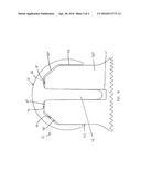 FEMORAL HEAD RESURFACING IMPLANT diagram and image