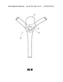 VASCULAR REMODELING DEVICE diagram and image