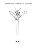 VASCULAR REMODELING DEVICE diagram and image