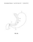 SATIATION DEVICES AND METHODS diagram and image