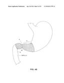 SATIATION DEVICES AND METHODS diagram and image