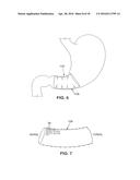 SATIATION DEVICES AND METHODS diagram and image