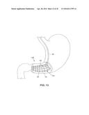 SATIATION DEVICES AND METHODS diagram and image