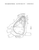 DELIVERY DEVICES AND METHODS FOR LEADLESS CARDIAC DEVICES diagram and image