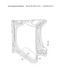 IMPLANTABLE NASAL STIMULATOR SYSTEMS AND METHODS diagram and image