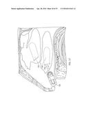 IMPLANTABLE NASAL STIMULATOR SYSTEMS AND METHODS diagram and image