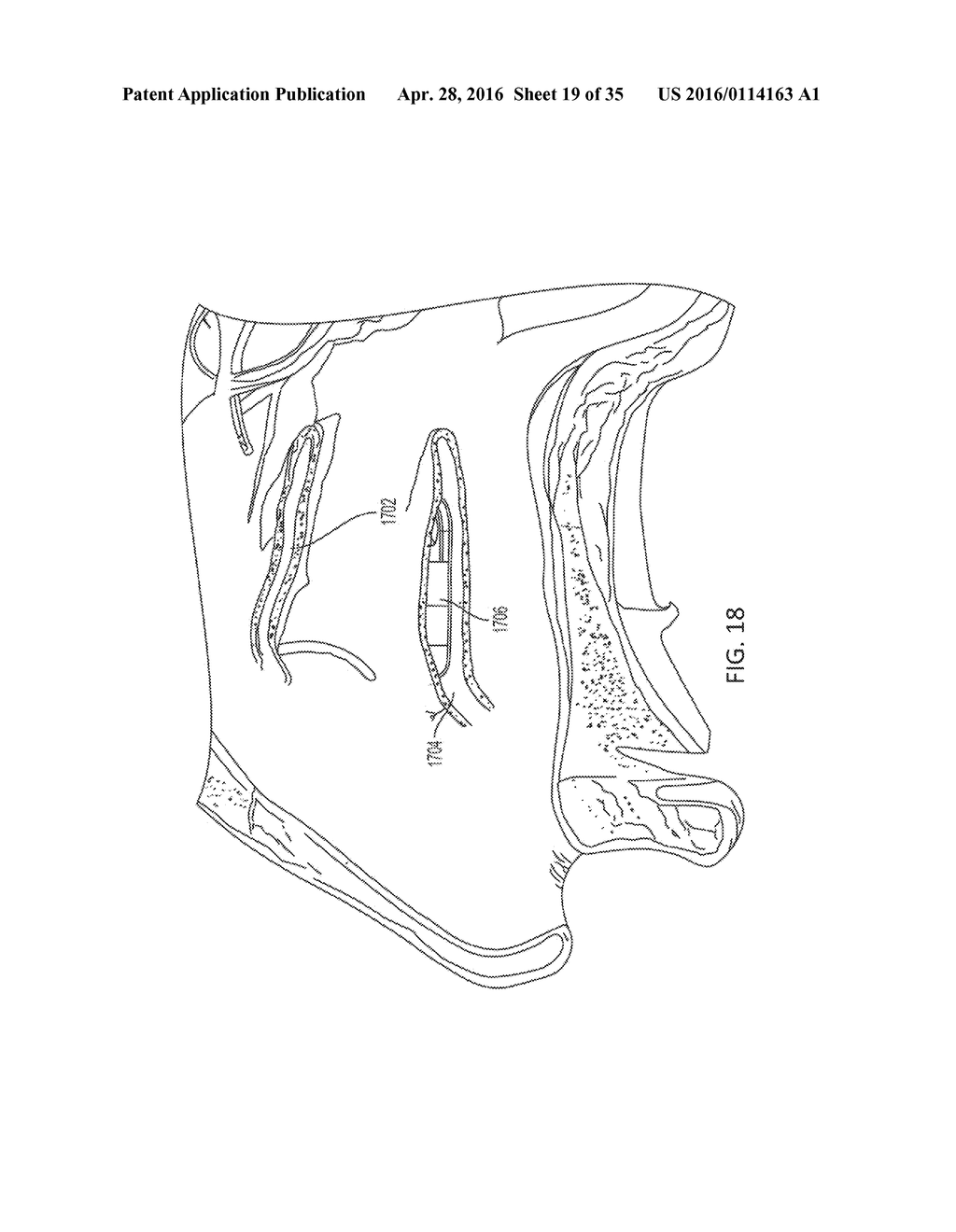 IMPLANTABLE NASAL STIMULATOR SYSTEMS AND METHODS - diagram, schematic, and image 20