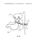 APPARATUS AND METHODS FOR CORRECTIVE GUIDANCE OF EATING BEHAVIOR AFTER     WEIGHT LOSS SURGERY diagram and image