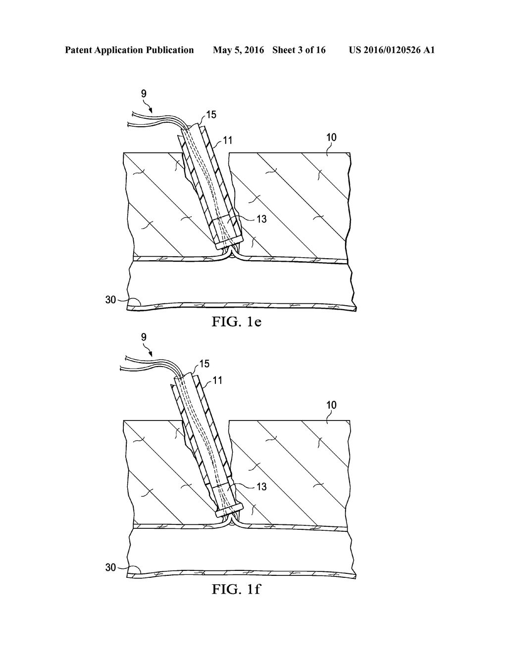 VASCULAR CLOSURE APPARATUS AND RELATED METHOD - diagram, schematic, and image 04