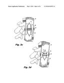 SURGICAL RETRACTOR SYSTEM AND METHOD diagram and image