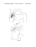 MEDICAL IMPLANT DELIVERY SYSTEM AND RELATED METHODS diagram and image