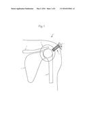 METHOD OF PROVIDING FOR THE MINIMIZATION OF EXTRAVASATION DURING     ARTHROSCOPIC SURGERY diagram and image